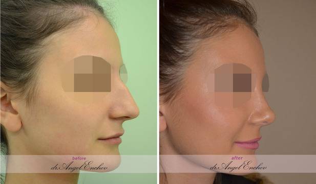 Естетична корекция на нос в Пластична хирургия д-р Ангел Енчев – За повече самочувствие!