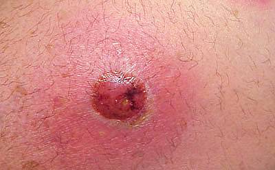 Многоликият абсцес може да причини много усложнения