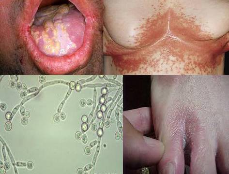 Гъбички /Кандида/