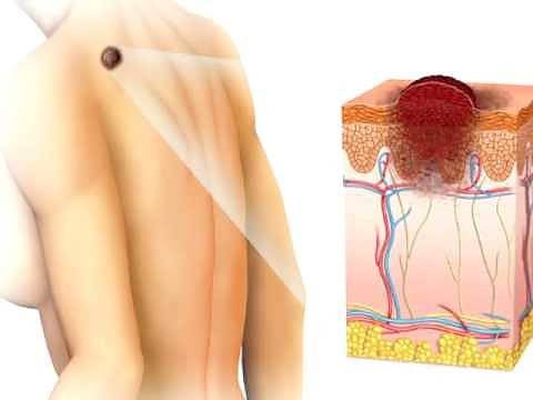 Липсва Zelboraf: Животоспасяващо онкологично лекарство