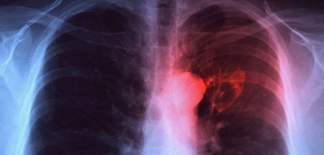 Безплатни прегледи за туберкулоза в цялата страна