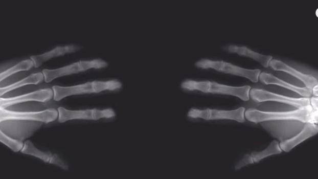 Чудили ли сте се какво се случва, когато изпукате кокалчетата на ръцете си?