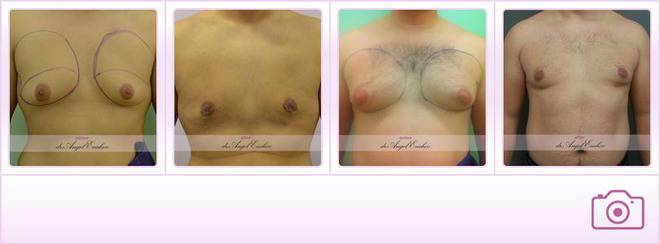 Гинекомастия е уголемяване на гърдите при мъжа, тип „женски гърди“