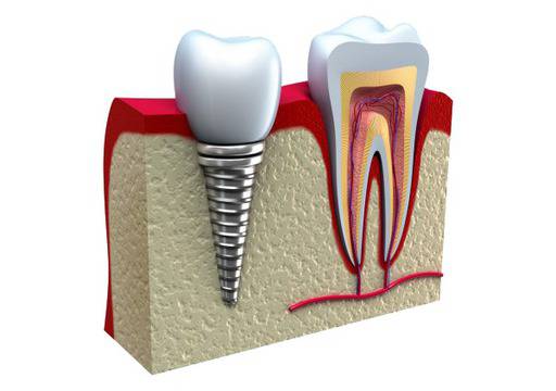 Брекети, брекети цени, брекети софия