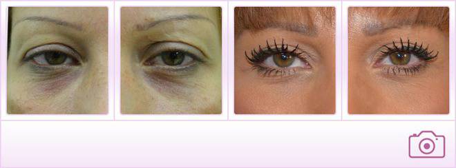 Болезнена ли е процедурата при опъване на бръчките около очите и колко струва