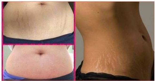 Как да Премахнем Стриите по Кожата