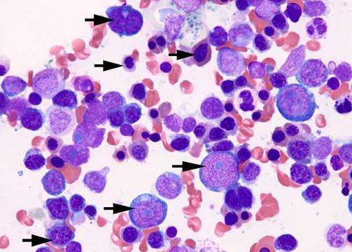 Лекарство с обещаващи резултати при остра миелоидна левкемия при деца