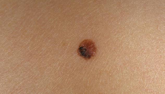 Как се премахват бенки и меланом