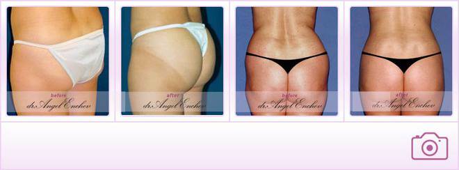 Лифтинг на седалище – Пластична хирургия д-р Ангел Енчев