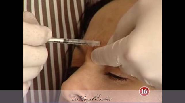 Заличаване на бръчки с ботокс и естетични процедури за лице – Пластична хирургия д-р Ангел Енчев