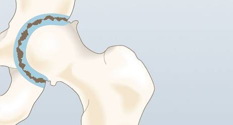 Какви са първите симптоми на артрозата?