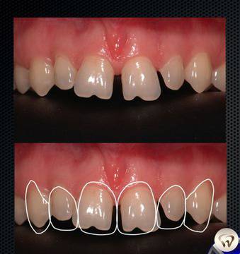 Порцеланови фасети