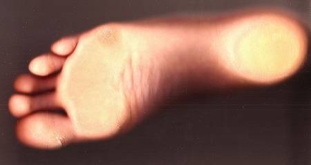 Студени крайници