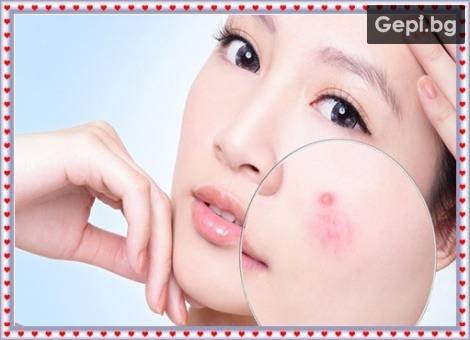 С чисто лице на бала! PTF фототерапия за лечение на акне и белези от акне!