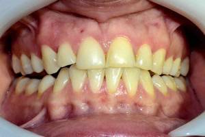 Избелване на зъби в домашни условия или в кабинета. София