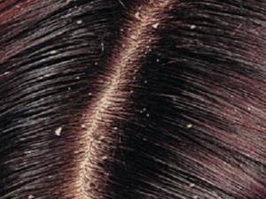 Бактерии по скалпа са причина за пърхота