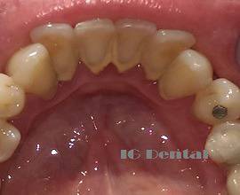 Почистване на зъбен камък