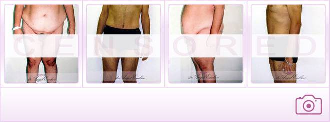 Лапароскопско поставяне на Гастрален пръстен – Лечение на наднормено тегло – Пластична хирургия д-р Ангел Енчев