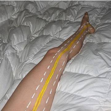 Лифтинг или пластика на бедрата при отпусната кожа от вътрешната им страна – Пластична хирургия д-р Ангел Енчев