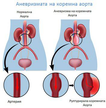 ЗАБОЛЯВАНЕ НА АОРТАТА