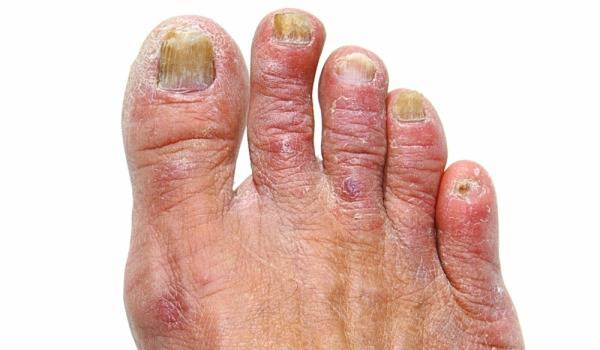 Гъбички по краката