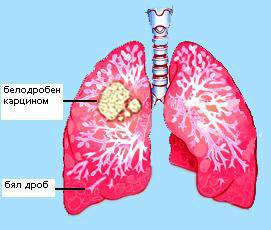 НОВА СХЕМА ЗА ЛЕЧЕНИЕ НА ПАЦИЕНТИТЕ С АВАНСИРАЛ РАК НА БЕЛИЯ ДРОБ