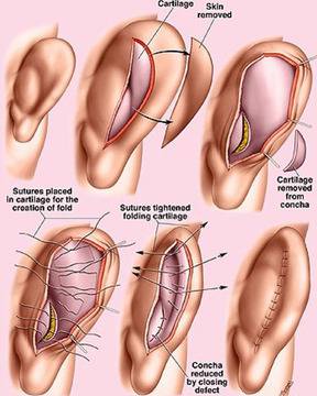 Отопластика или Аурикулопластика – Пластична хирургия д-р Ангел Енчев