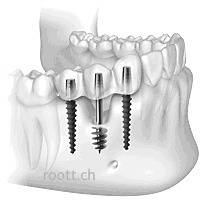Възможно ли е зъбните импланти да бъдат отхвърлени?