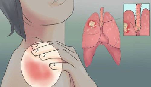 Внимание!!! Вижте как да разпознаете ранните признаци за рак на белия дроб!