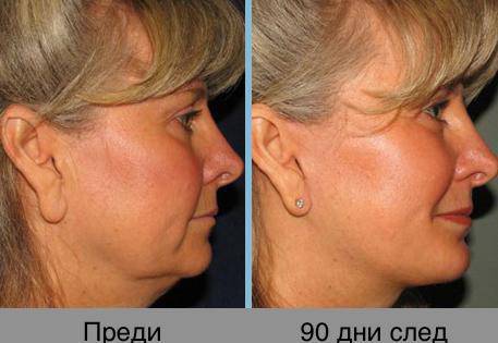 Неоперативна процедура за лифтинг на лице (Хайфу технология)