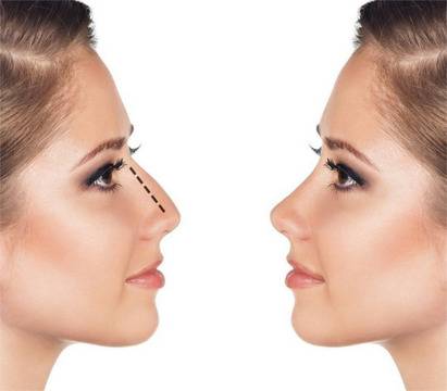 Видове и цел на ринопластиката (пластика за корекция на нос)