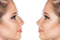 Видове и цел на ринопластиката (пластика за корекция на нос)