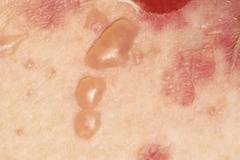 При пемфигус по кожата се появяват мехури без видима причина