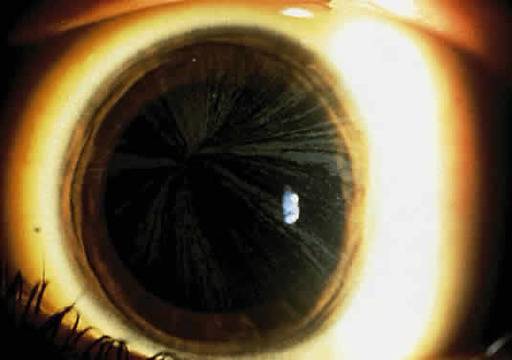 Ранен инсулт може да е симптом на болестта на Фабри