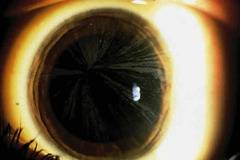 Ранен инсулт може да е симптом на болестта на Фабри