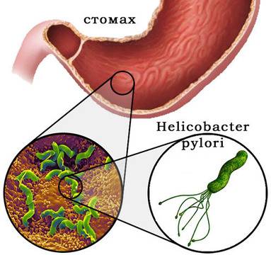 Терапия срещу Хеликобактер Пилори при основно заболяване Склеродермия
