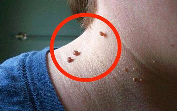 Домашна рецепта за безболезнено премахване на папиломи, фиброми и брадавици