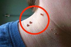 Домашна рецепта за безболезнено премахване на папиломи, фиброми и брадавици