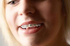 Тайванец изобрети шини за зъби за по-добро фелацио