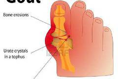 Фруктозата в безалкохолните виновна за епидемията от подагра