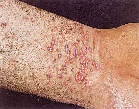 Безплатни прегледи за контактен дерматит в 5 града