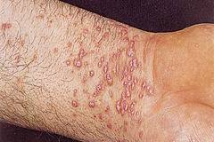 Безплатни прегледи за контактен дерматит в 5 града