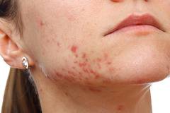 Премахване на белези от акне