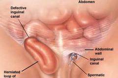 Какви са причините за херния?