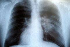 Безплатни прегледи за туберкулоза в цялата страна