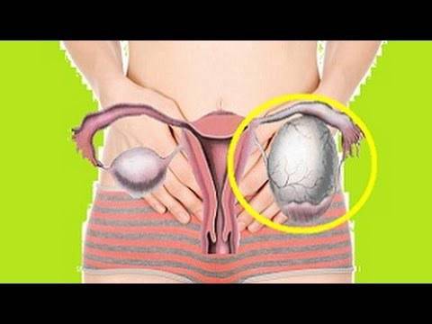 Как да разпознаем ранните признаци на киста?