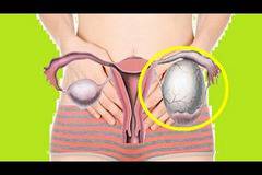 Как да разпознаем ранните признаци на киста?