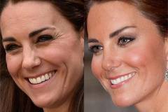 Чудесата на Botox