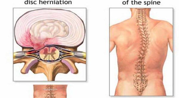 Лечение на дискова херния и как да се предпазим от нея! Най-подробната статия!
