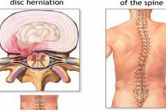 Лечение на дискова херния и как да се предпазим от нея! Най-подробната статия!